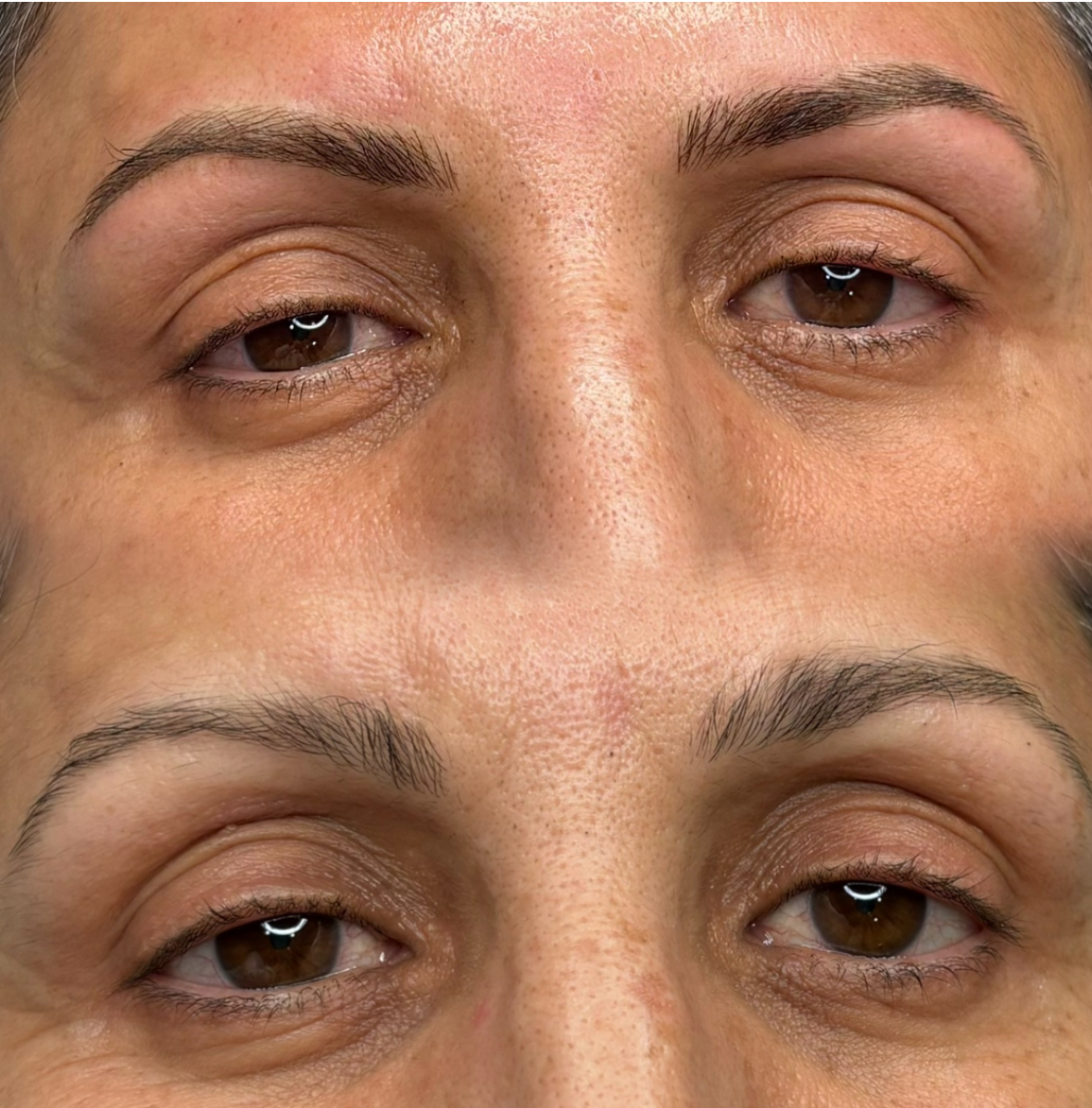 Estimulación folicular